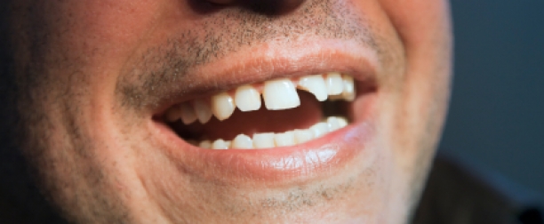 Fractura coroanei dentare